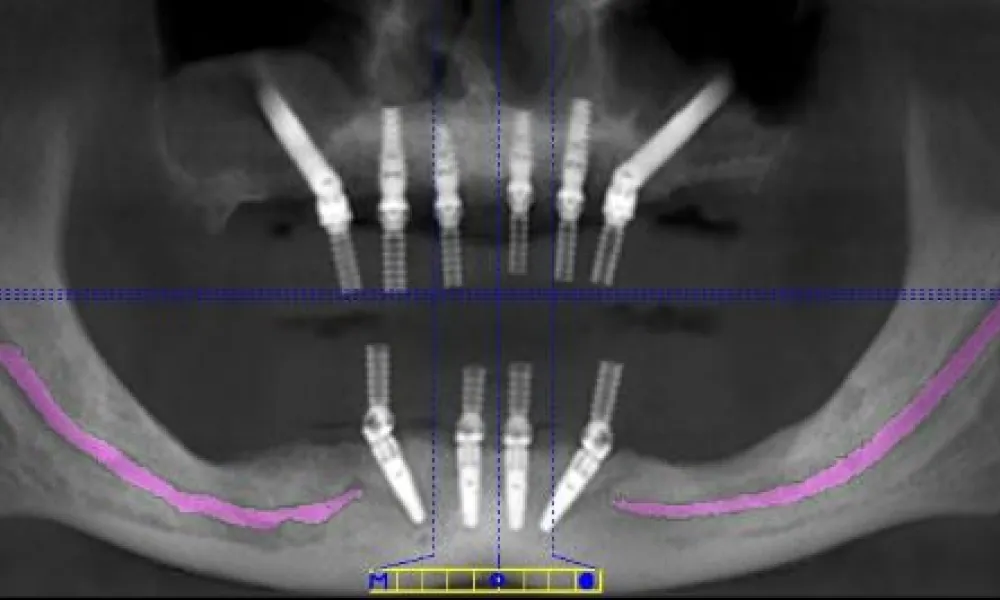 Clinical photo from Ron's dental implant case